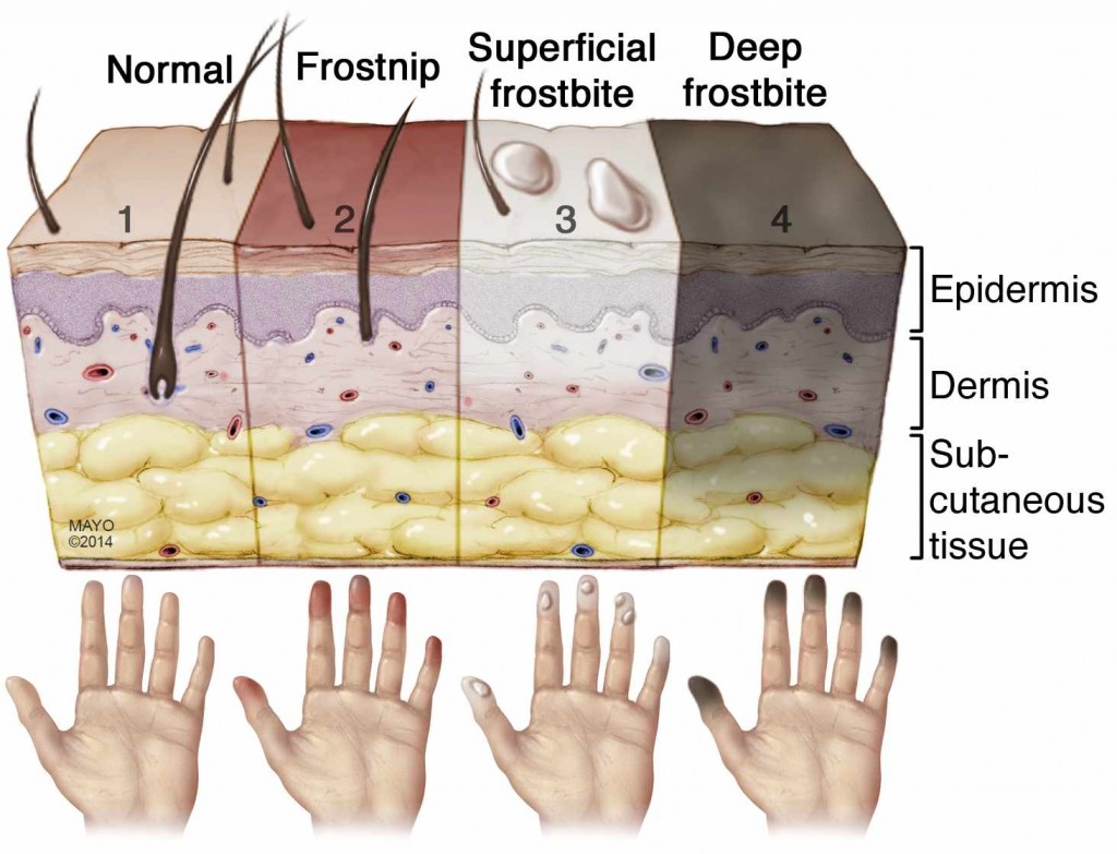 illustration of stages of frostbite and how it affects the skin