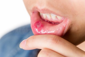 woman suffering from mouth aphtha canker sore on lip