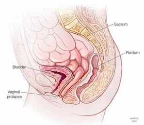 Ilustración del prolapso vaginal