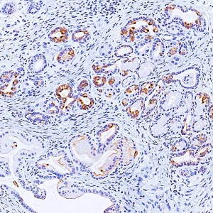 The image shows typical pancreatic precancerous lesions. Brown staining shows upregulation of the protein PKD1.