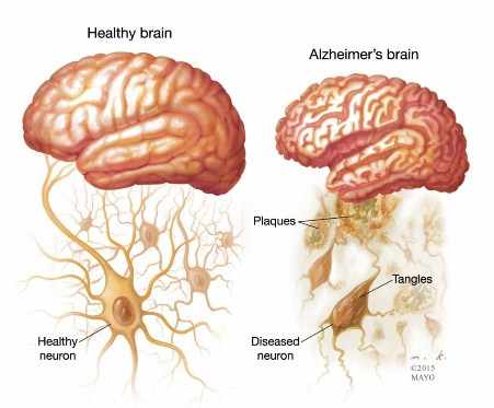 ilustración de un cerebro sano y otro con la enfermedad de Alzheimer