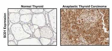 Láminas que muestran la proteína SCD1 en tejido tiroideo normal y en tejido de carcinoma anaplásico de tiroides.