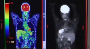 cancer imaging for HBO measles virus documentary