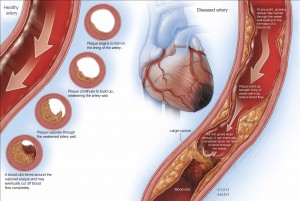 Ilustración médica de la arteriopatía coronaria
