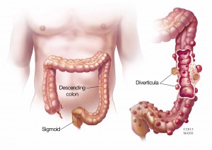 illustration of colon with diverticula, diverticulitis,