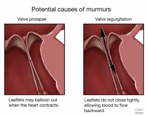 illustration of valve prolapse, heart murmur