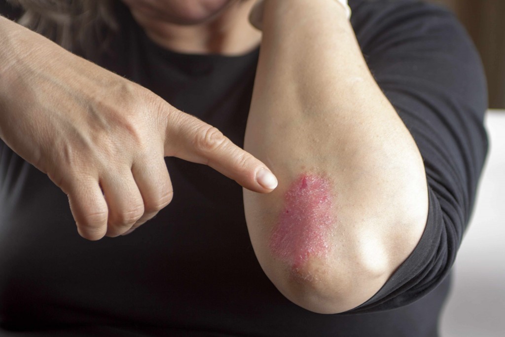 Living with psoriasis: Skin care tips and treatments