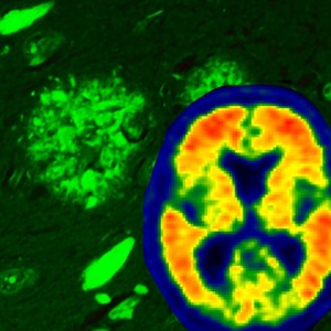 Alzheimer's disease brain pathology is illustrated using thioflavin-S fluorescent microscopy, which reveals both neurofibrillary tangles (flame-shaped structures) and amyloid plaque pathology (rounded structures). Through the use of the amyloid brain scanning, we are now able to visualize amyloid accumulation in the brains of living individuals – visualized with warmer colors.
