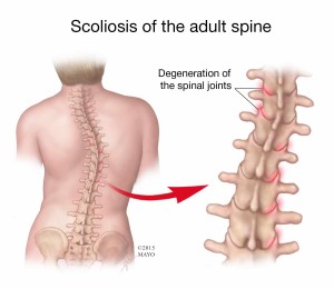 scoliosis of the adult spine - illustration