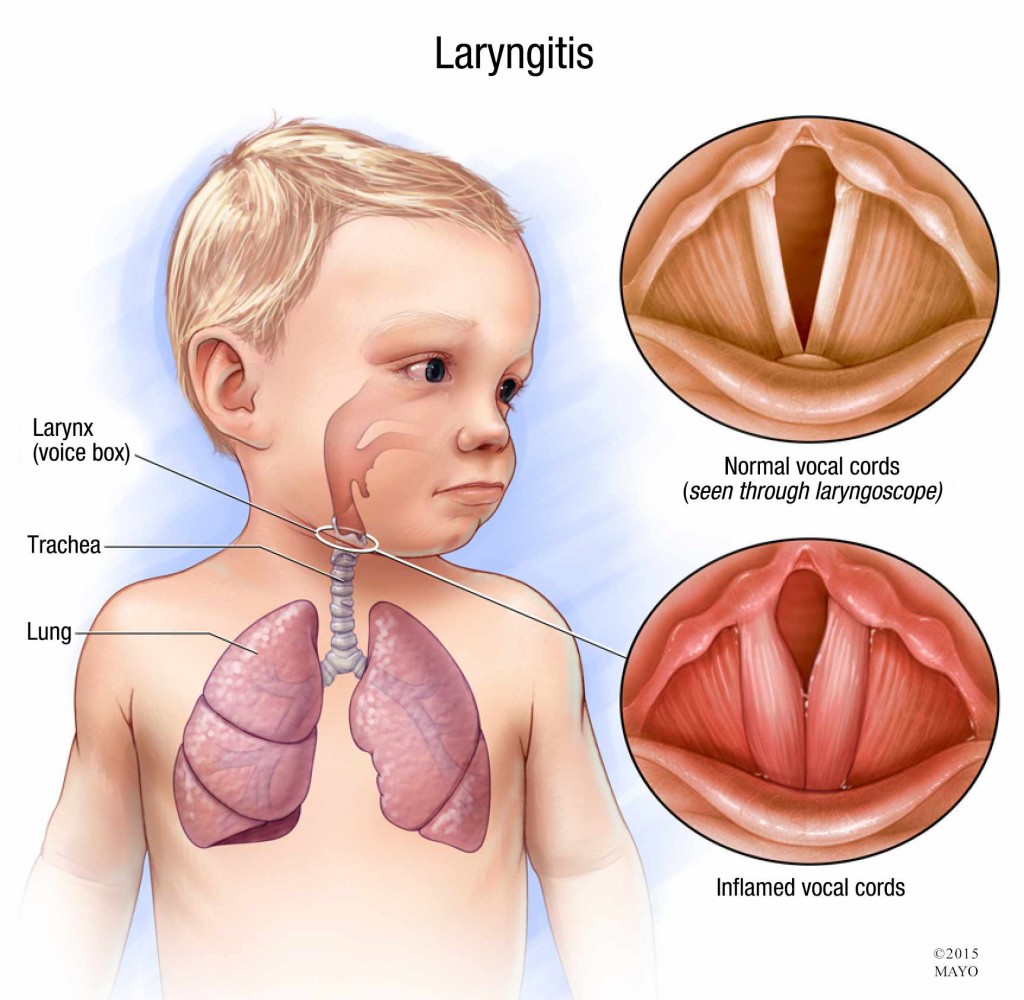 illustration of child with laryngitis