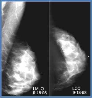 Imagen de tejido mamario denso con cáncer