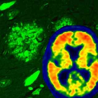 Exploración que revela la patología de un cerebro con la enfermedad de Alzheimer: ovillos neurofibrilares y placa amiloide