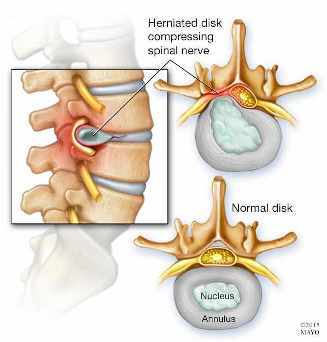 Ilustración de una hernia de disco en la columna vertebral (arriba) y de un disco normal (abajo)