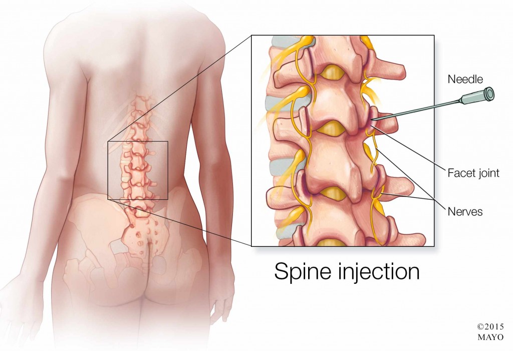 illustration of spine injection, corticosteroid injection 