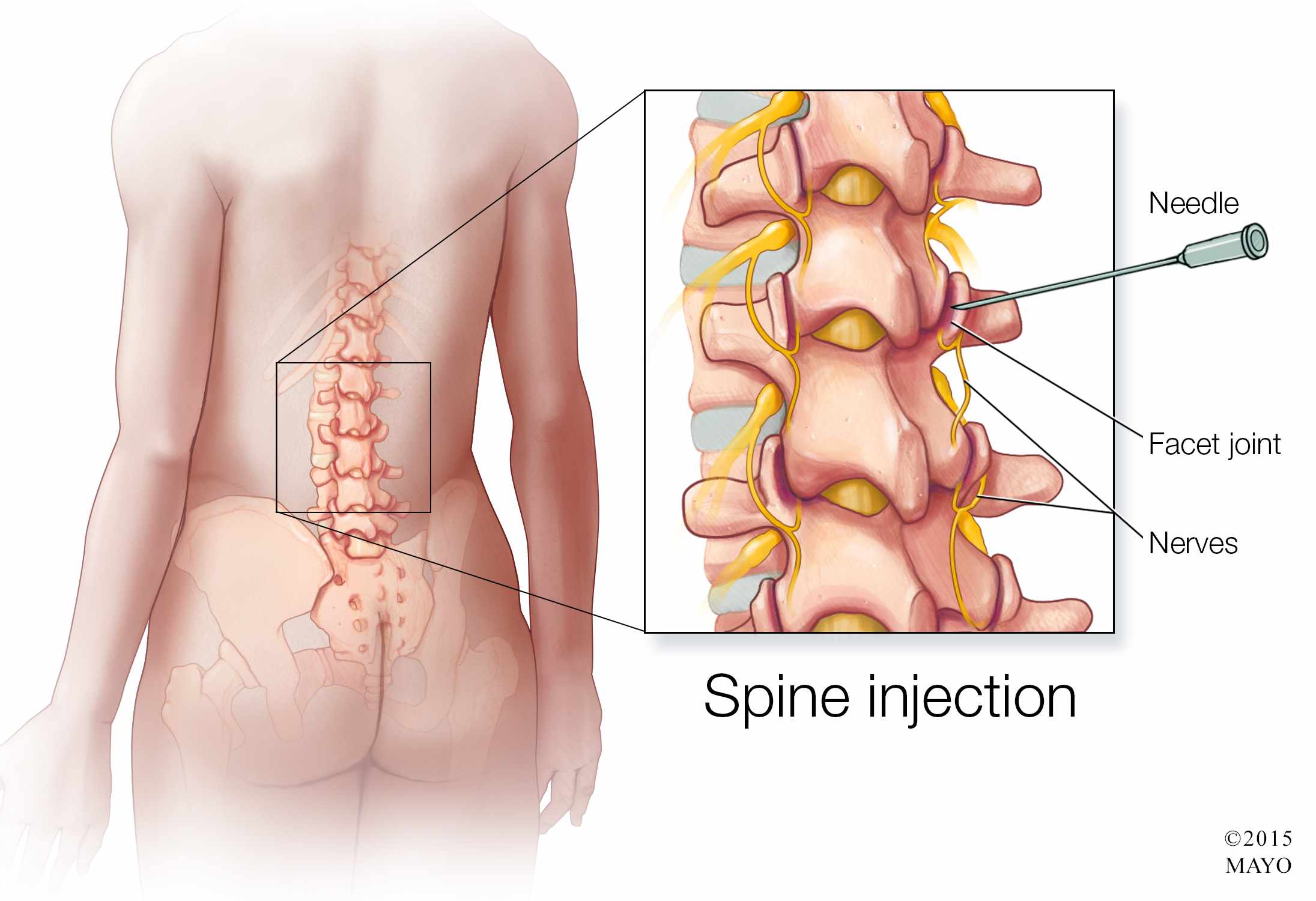 Herniated disk - Diagnosis and treatment - Mayo Clinic