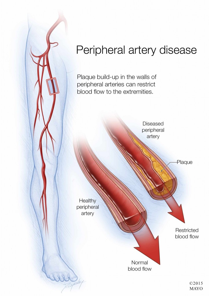 illustration of peripheral artery disease