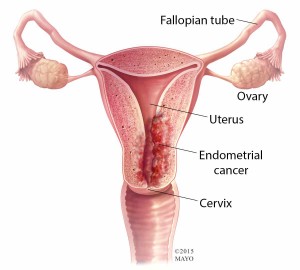 illustration of uterus, fallopian tubes, ovaries, cervix, endometrial cancer, gynecological surgery