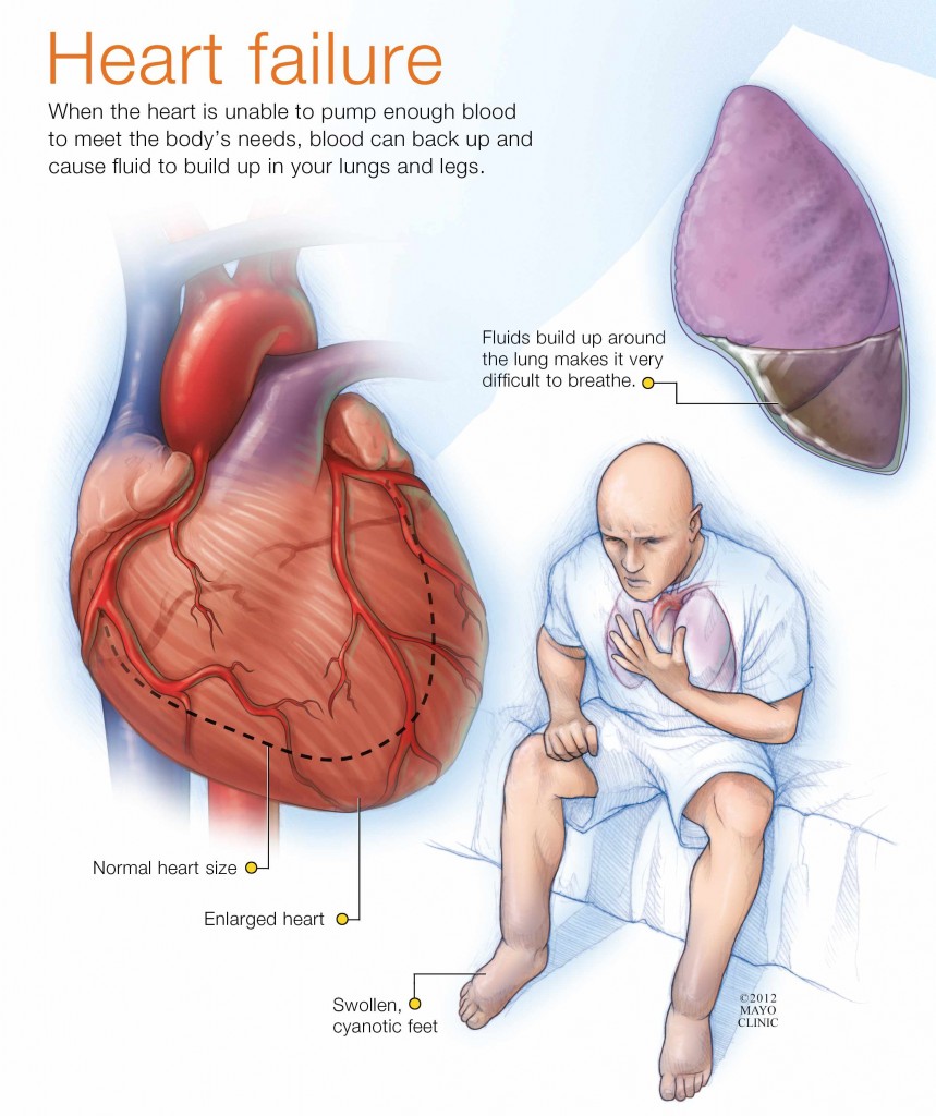 Ilustración de un hombre con insuficiencia cardíaca