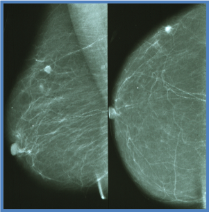 Imagen de tejido mamario no denso con cáncer