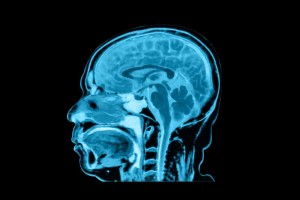 Side view of MRI brain scan