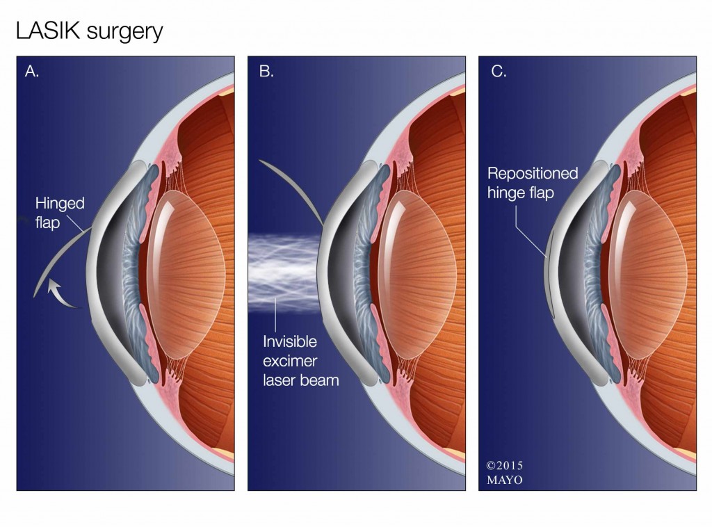 illustration of LASIK surgery for eye sight