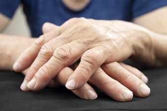 Acercamiento de manos con artritis reumatoide