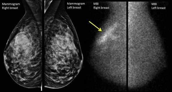 Imágenes una al lado de la otra de mamografía e imágenes moleculares de las mamas