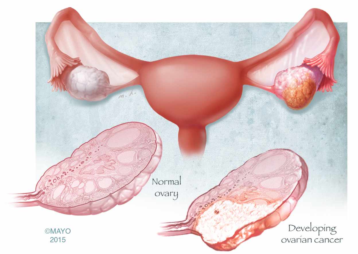illustration of ovaries, normal ovary and ovary developing cancer