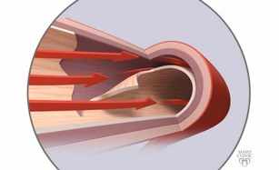 Ilustración de un desgarre de la aorta