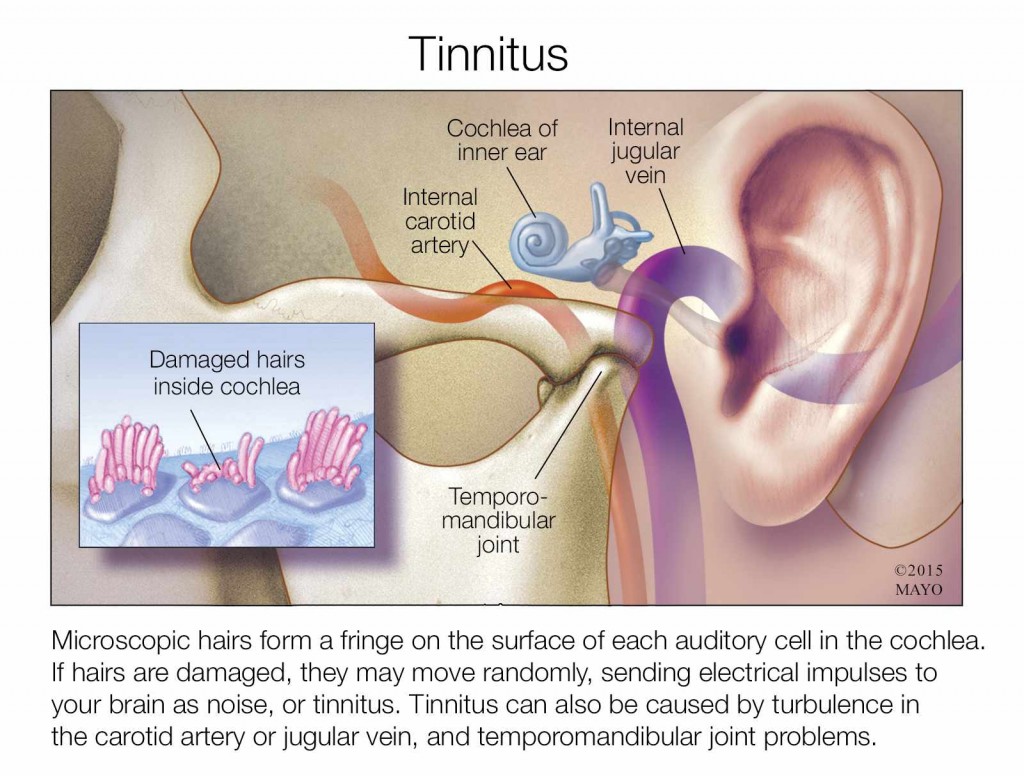 illustration of ear with tinnitus