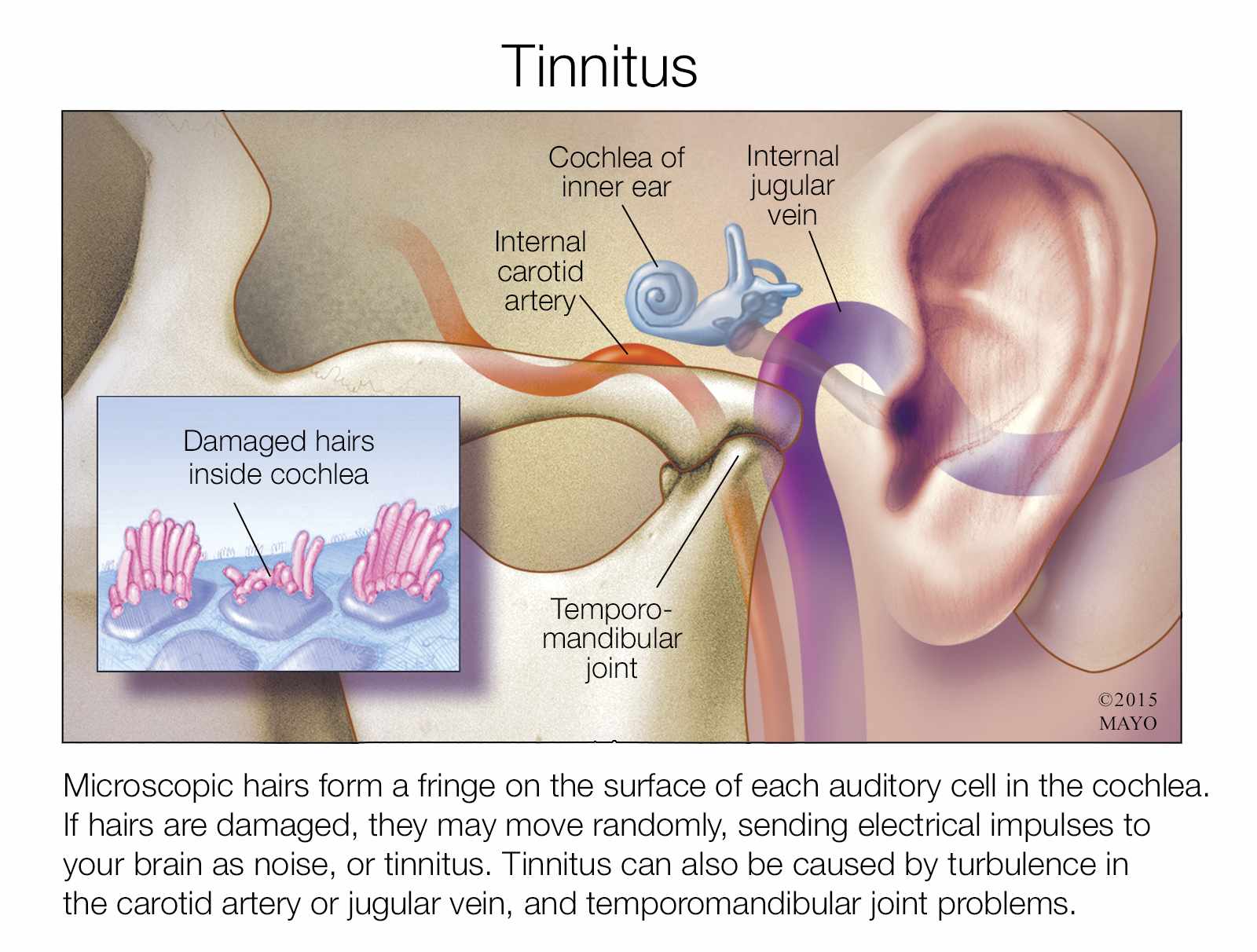 marmeren overloop Verplicht Mayo Clinic Q and A: Tinnitus can interfere with hearing but doesn't cause  hearing loss - Mayo Clinic News Network