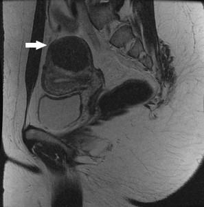 A magnetic resonance image of a fibroid