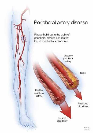 Ilustración de la enfermedad arterial periférica