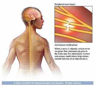 Ilustración médica de la lesión de un nervio periférico con la activación inadecuada de ciertos receptores nerviosos
