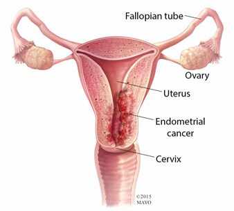 Ilustración del útero, trompas de Falopio, ovarios, cuello uterino y cáncer de endometrio