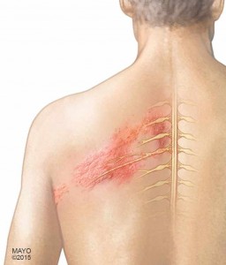 illustration of man with Shingles along his back