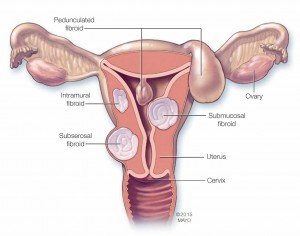 Medical illustration of a woman's reproductive system highlighting the different types of uterine fibroids
