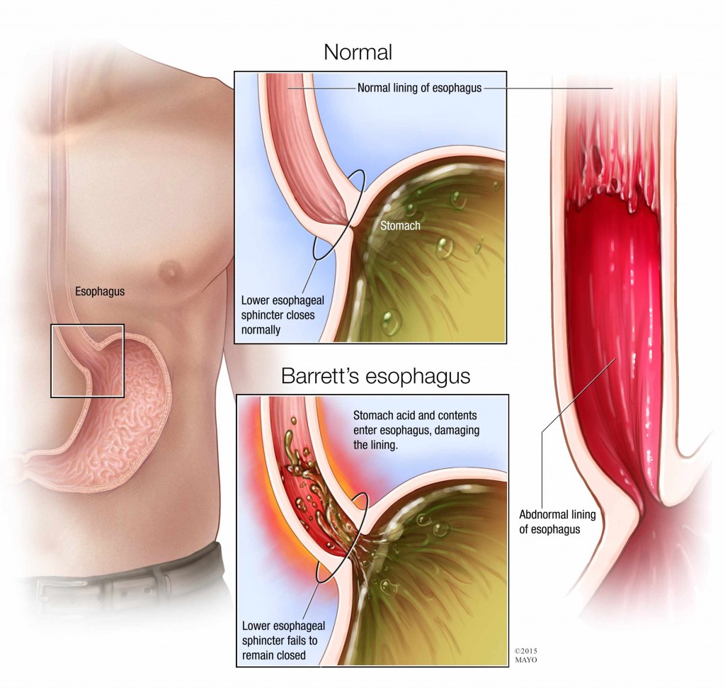 illustration of normal esophagus and Barrett's esophagus