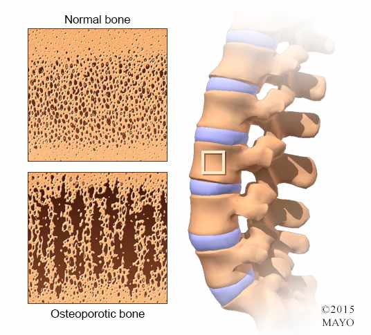 close up illustration of spine with osteoporosis, bone loss