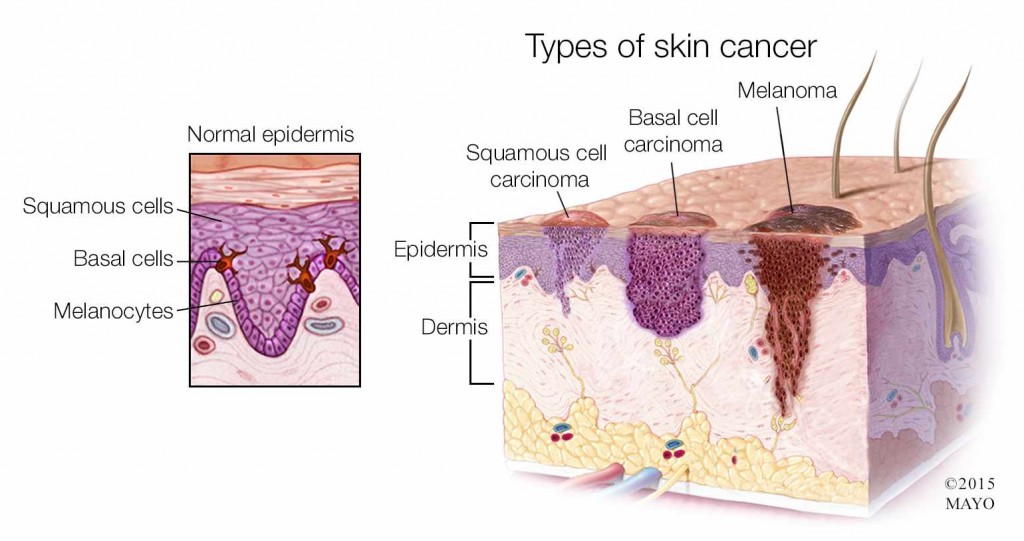 Ilustración médica de los tipos de cáncer de piel: melanoma, carcinoma basocelular y carcinoma de células escamosas