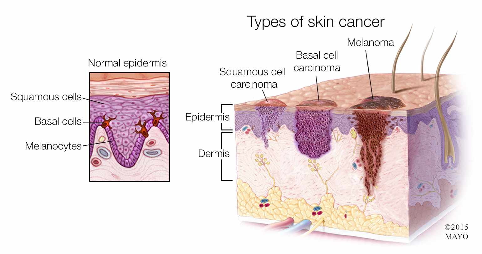Mayo Clinic Minute 3 Types Of Skin Cancer Mayo Clinic News Network