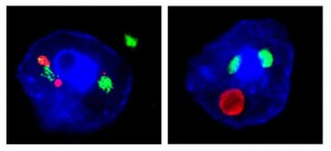 Pictured are nuclei (blue) of neurons in the ALS/FTD mouse model  showing they contain inclusions of both RNA (left panel, red) or poly(GA) protein (right panel, red) and TDP-43 (both panels, green).