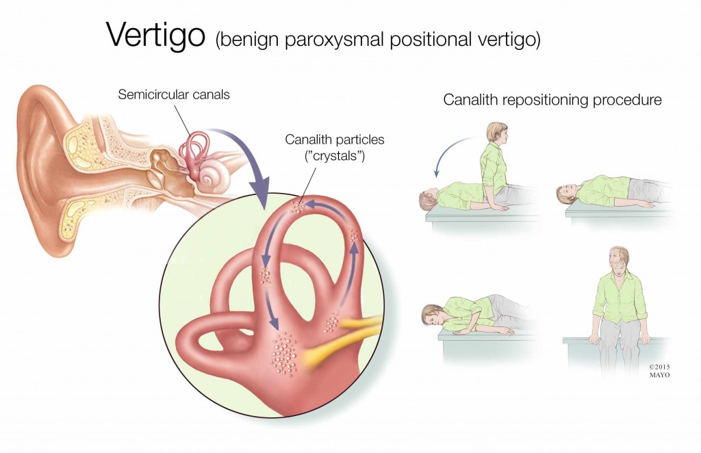 medical illustration of inner ear describing vertigo