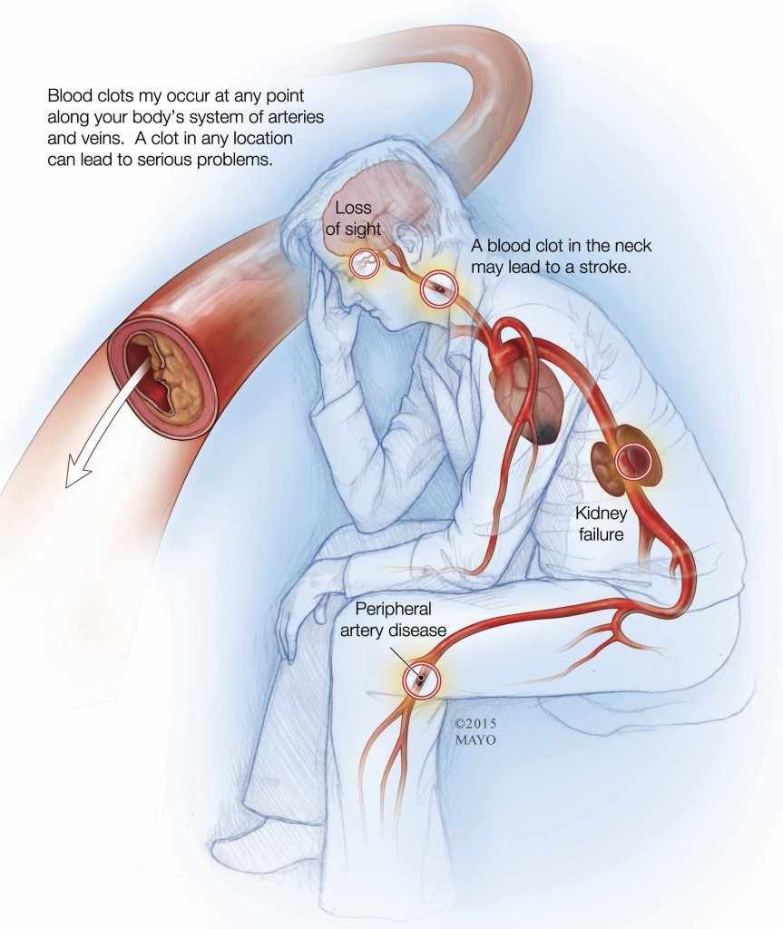 Ilustración de las posibles complicaciones de los coágulos sanguíneos