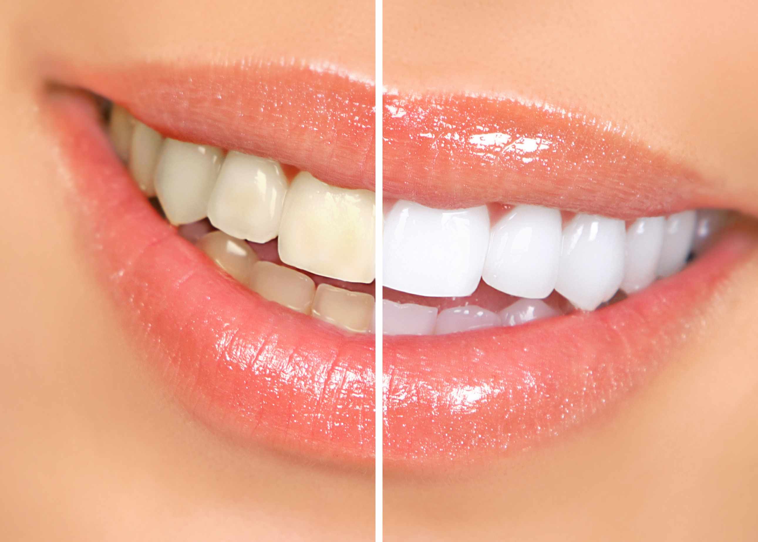 Mayo Clinic Q And A Many Safe Choices Available To Help Whiten Teeth 