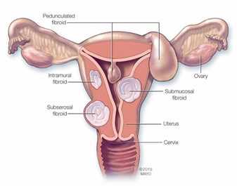Ilustración médica del sistema reproductivo femenino donde resaltan los diferentes tipos de fibromas uterinos