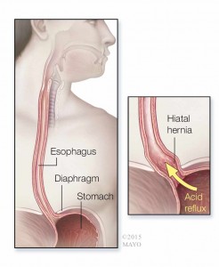 medial illustration of espophagus, diaphragm, stomach, acid refluc and hiatal hernia
