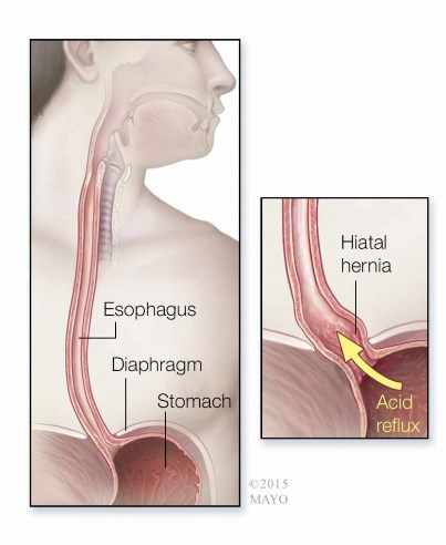 Ilustración médica del esófago, diafragma, estómago y reflujo ácido a la izquierda  y hernia de hiato a la derecha