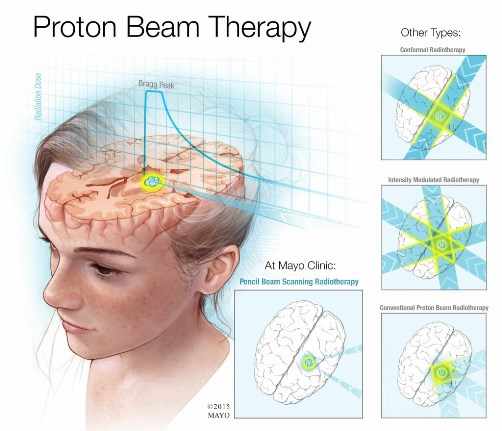 Child receiving proton beam therapy: pencil beam scanning radiotherapy