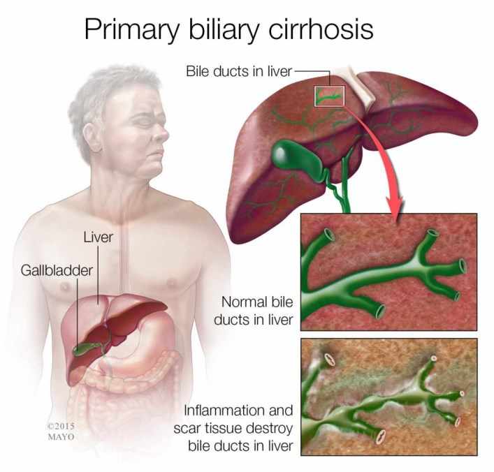 Ilustración médica de la cirrosis biliar primaria (en la parte inferior derecha)